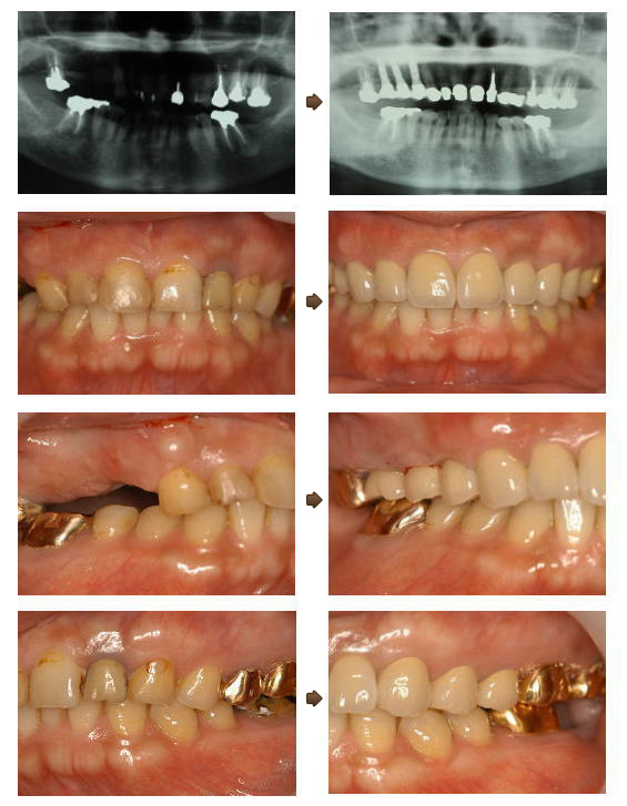 歯を数本失ったインプラント症例2