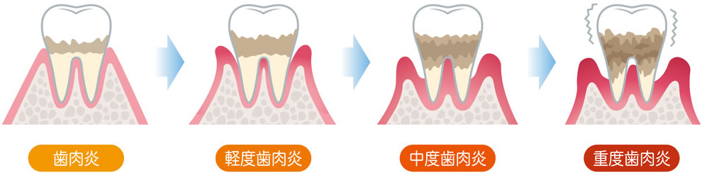 歯周病の進み方