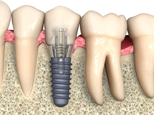 歯科インプラント