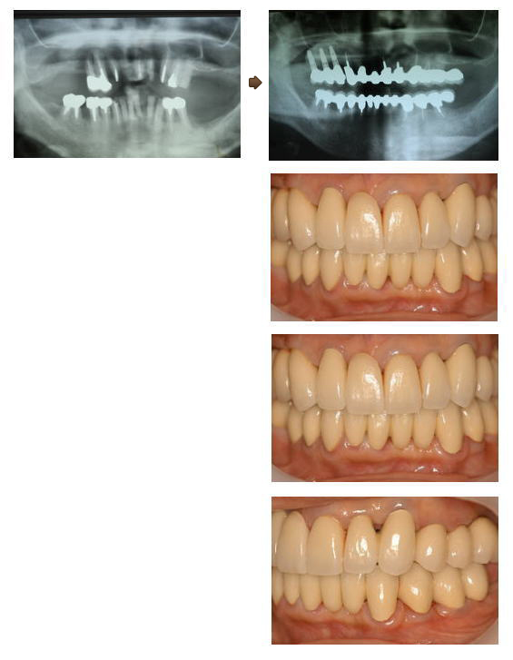歯を数本失ったインプラント症例1