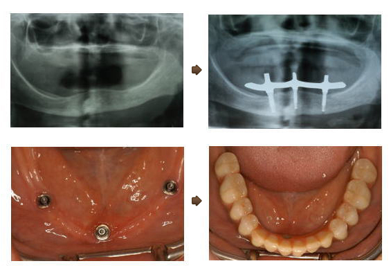 歯を全て失ったインプラントの症例